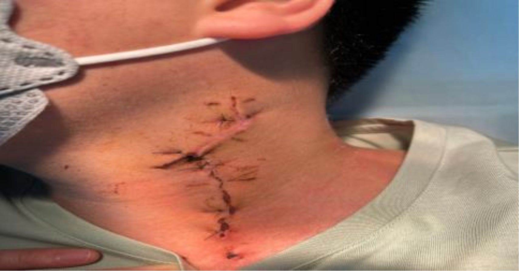 Báo cáo ca lâm sàng: Vết thương động mạch cảnh chung và tĩnh mạch cảnh trong trái