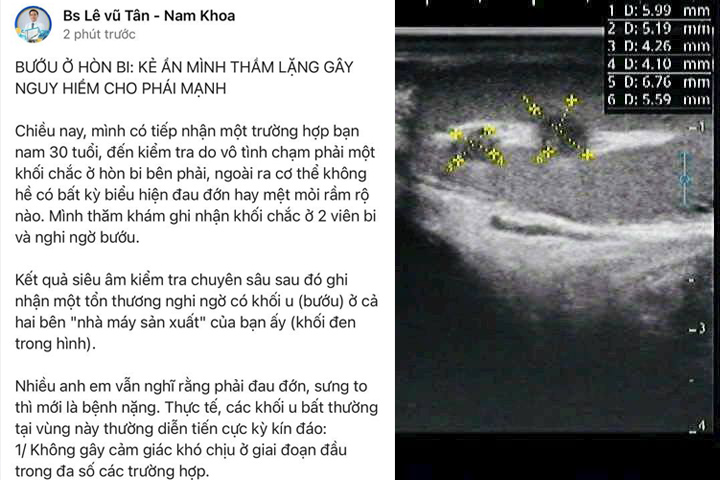 Bướu ở hòn bi: kẻ ẩn mình thầm lặng gây nguy hiểm cho phái mạnh