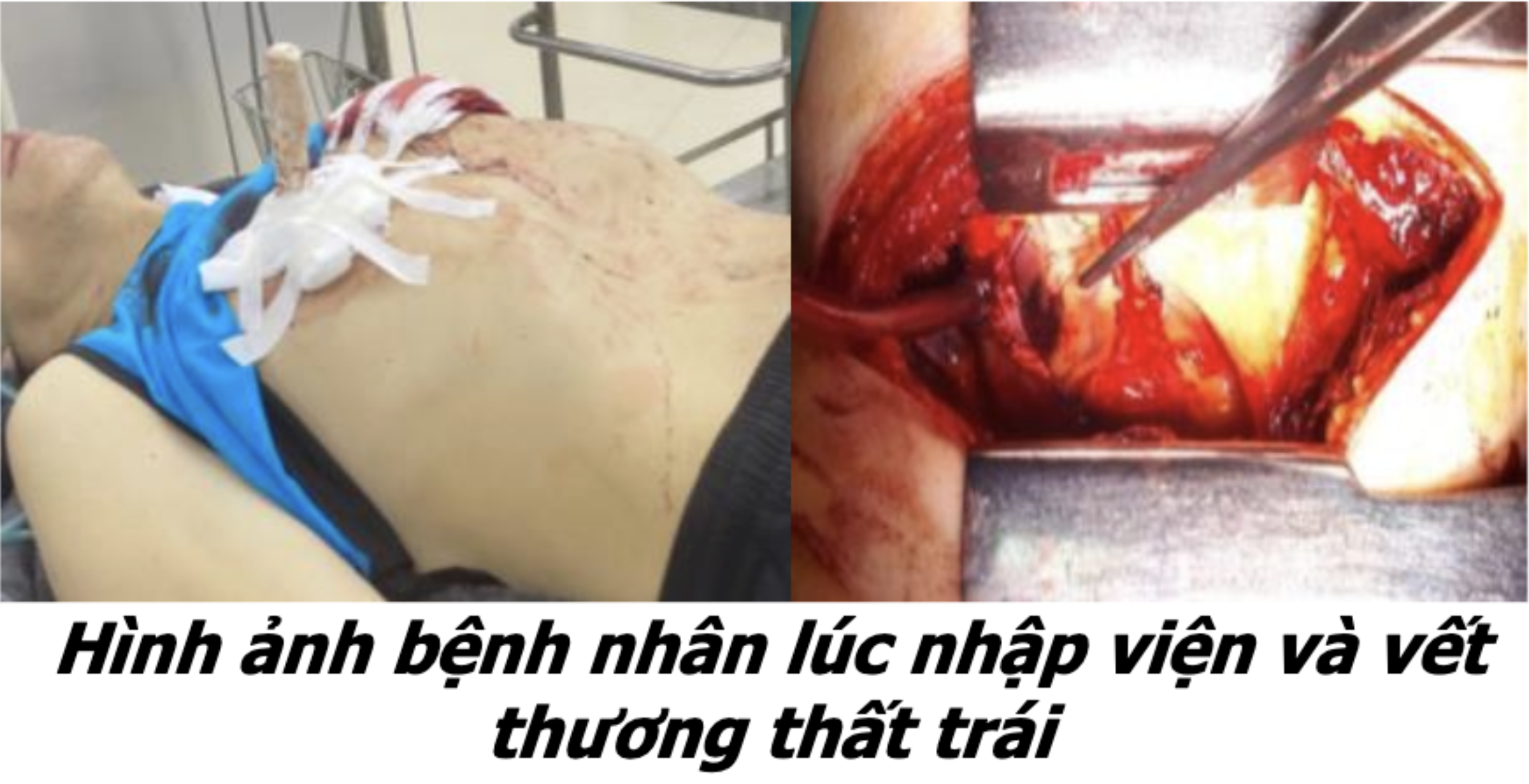 Báo cáo ca lâm sàng: Phẫu thuật bệnh nhân vết thương thấu phổi và thấu tim do tự đâm kết hợp bỏng thực quản do chất tẩy rửa