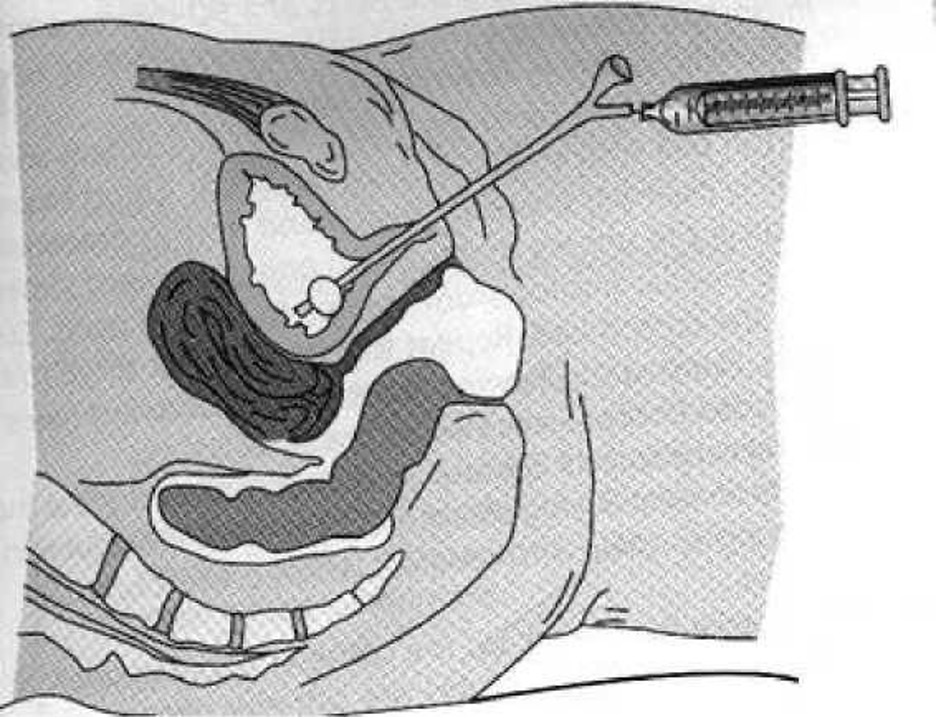 bí tiểu cơ năng.jpg