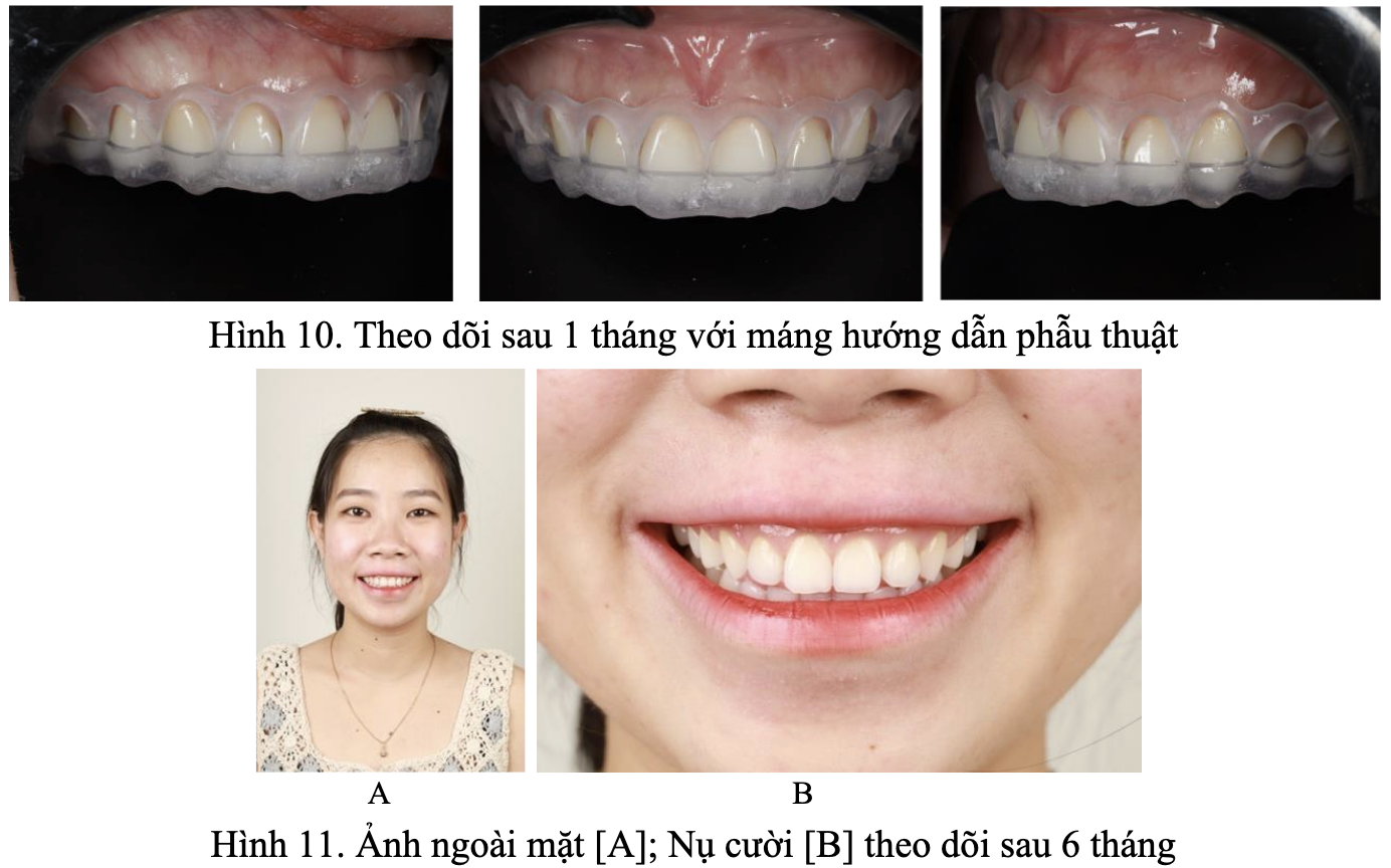 Báo cáo ca lâm sàng: Ứng dụng máng hướng dẫn phẫu thuật hai tầng trong điều trị cười lộ nướu