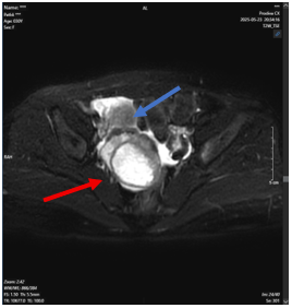 Ca lâm sàng: Điều trị ung thư phổi không tế bào nhỏ giai đoạn muộn tại Trung tâm Y học hạt nhân và Ung bướu - Bệnh viện Bạch Mai