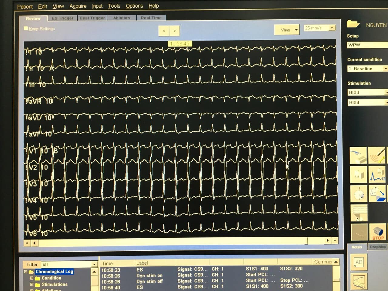 rối loạn nhịp.jpg