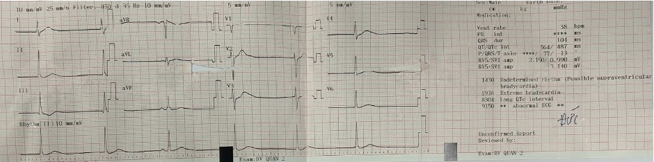 ECG lúc nhập viện.jpg