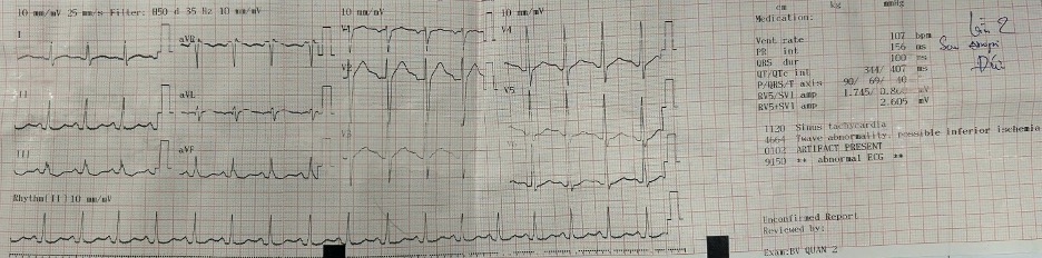 ecg sau nhâpk viện.jpg