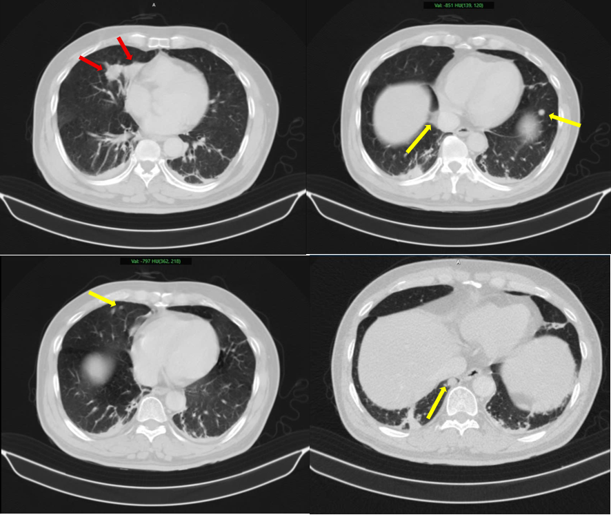 ung thư phổi và ung thư tuyến tiền liệt 1.png