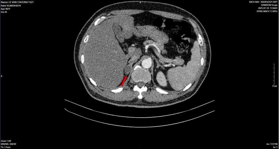 Điều trị thành công trường hợp hiếm gặp mắc đồng thời ung thư phổi và ung thư tuyến tiền liệt