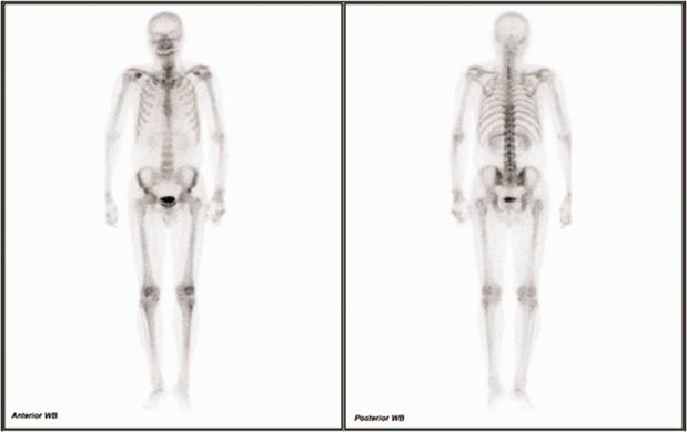 Chẩn đoán nhầm di căn đám rối cánh tay vùng trên đòn thành thoát vị đĩa đệm cổ