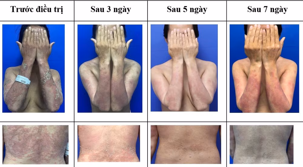 Điều trị thành công ca vảy nến thể mủ toàn thân nặng bằng thuốc sinh học mới