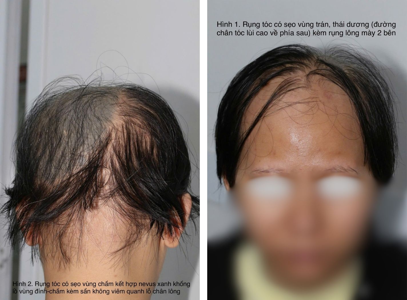 Chuyên gia Việt - Mỹ hội chẩn ca bớt xanh khổng lồ kèm rụng tóc xơ hóa có 1 không 2 trên thế giới
