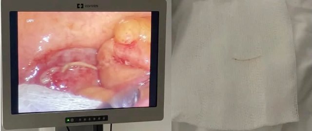 Mảnh xương cá "đi lạc" suốt nửa năm trong ổ bụng người phụ nữ