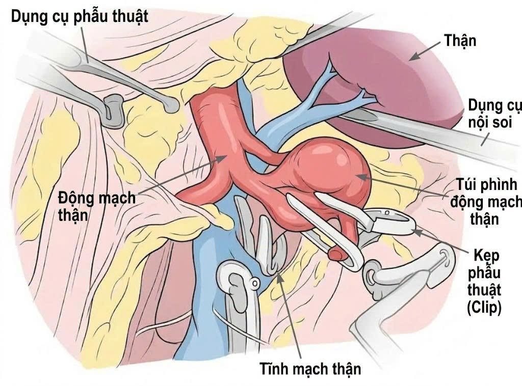 aca kep tinh mach than 2.jpg
